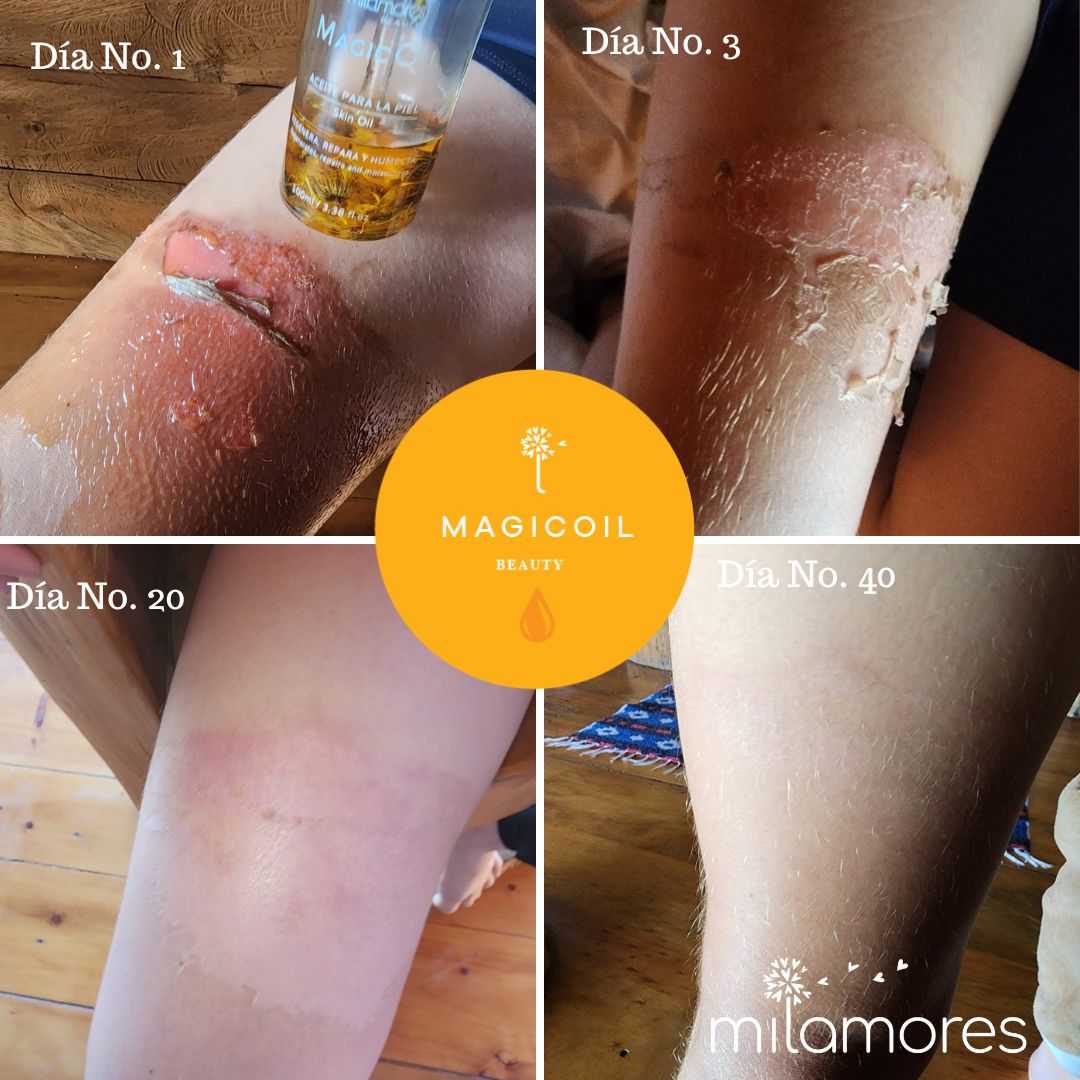 Cómo sané la quemadura de segundo grado de mi hijo con amor y productos naturales